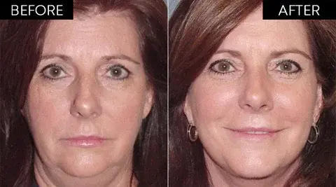 Before and after using Gelagen