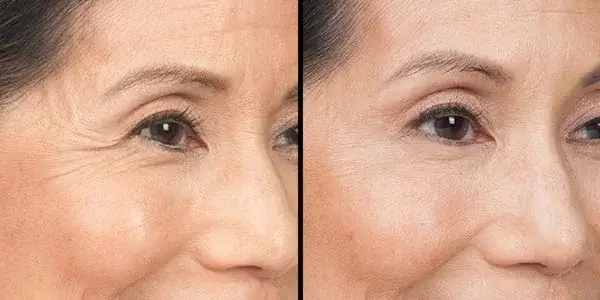 Before and after using Gelagen
