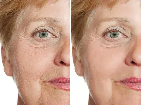 Before and after using Gelagen