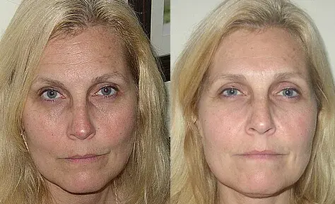 Before and after using Gelagen