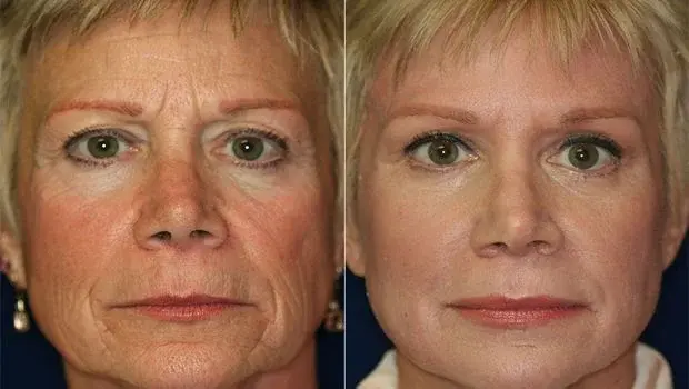 Before and after using Gelagen
